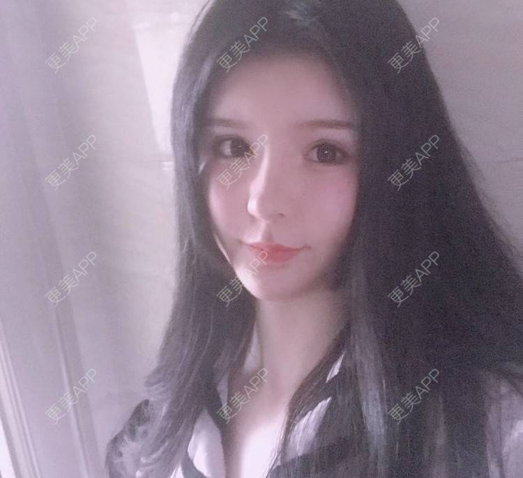 更美 - 老街上的猫的吸脂瘦脸经验 | 吸脂瘦脸 | 南昌