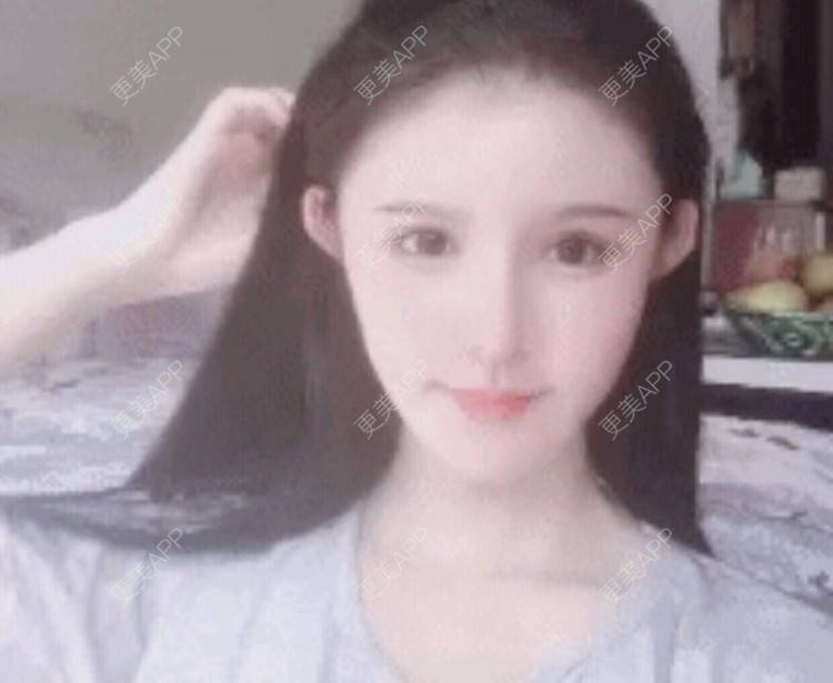 更美 - 老街上的猫的吸脂瘦脸经验 | 吸脂瘦脸 | 南昌