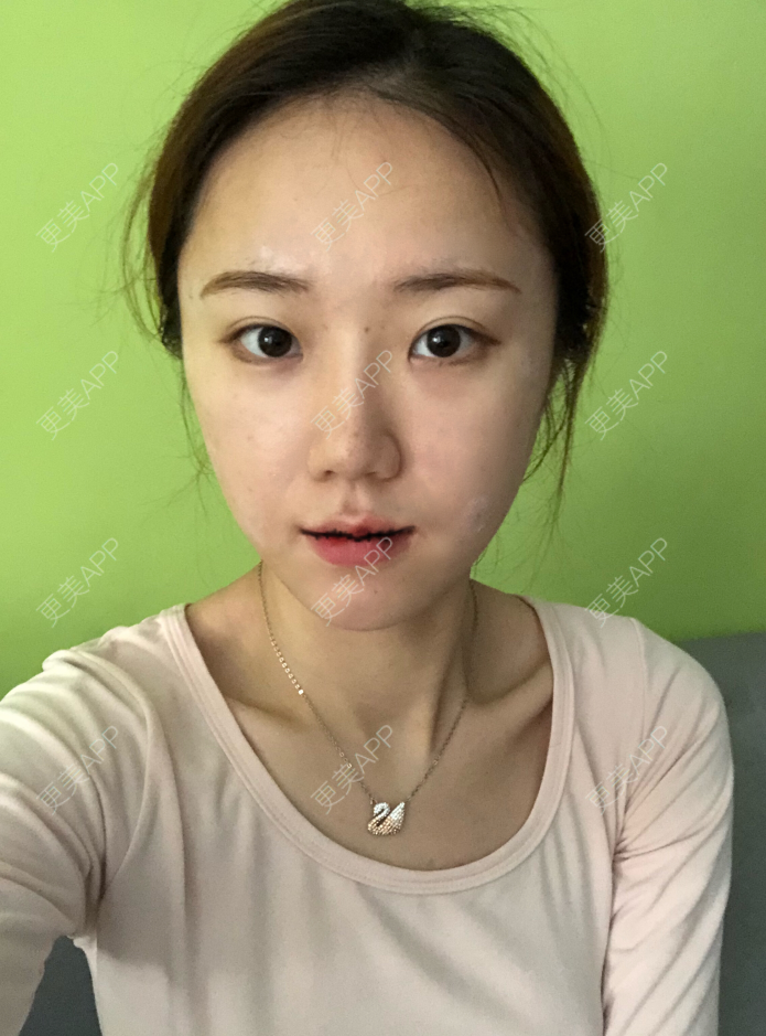 更美 - 疯女子爱爱逛的厚唇改薄经验 | 成都 | 厚唇改薄