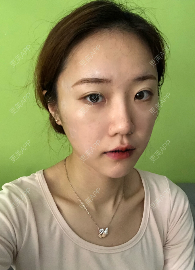 更美 - 疯女子爱爱逛的厚唇改薄经验 | 成都 | 厚唇改薄