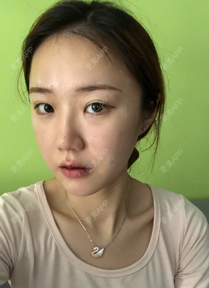 更美 - 疯女子爱爱逛的厚唇改薄经验 | 成都 | 厚唇改薄