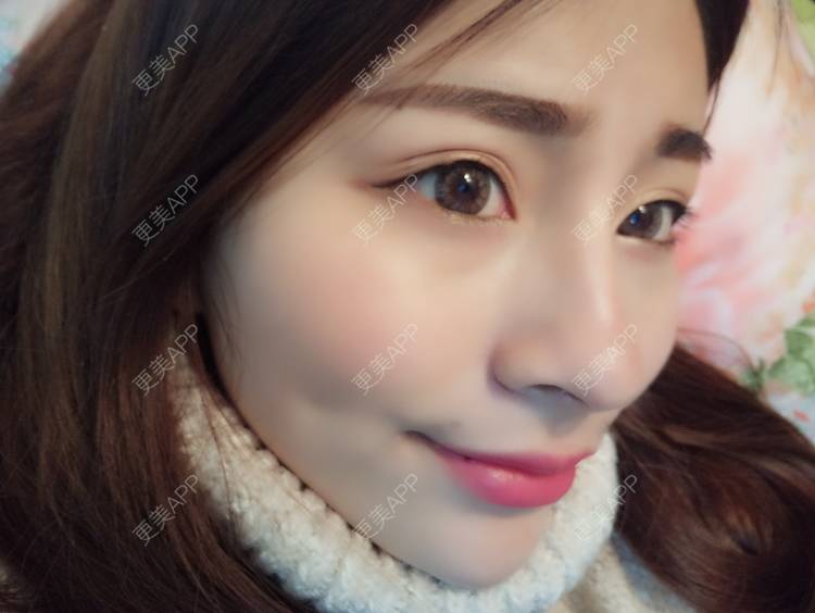 更美 - YOYO球的镭射净肤经验 | 广州 | 镭射净肤
