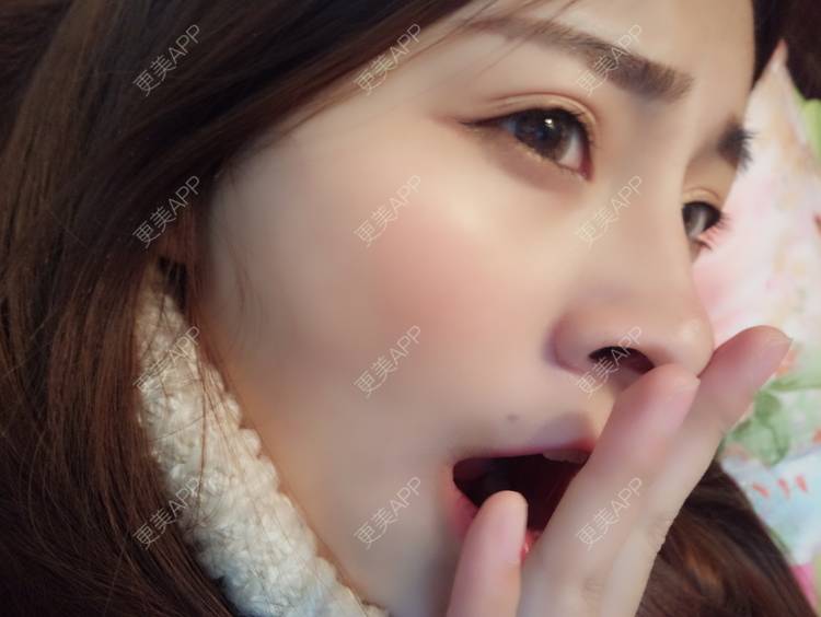 更美 - YOYO球的镭射净肤经验 | 广州 | 镭射净肤