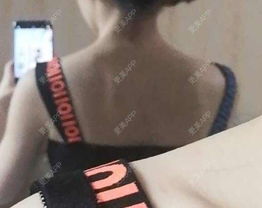 更美 - 王子涵涵的杯状耳矫正经验 | 杯状耳矫正
