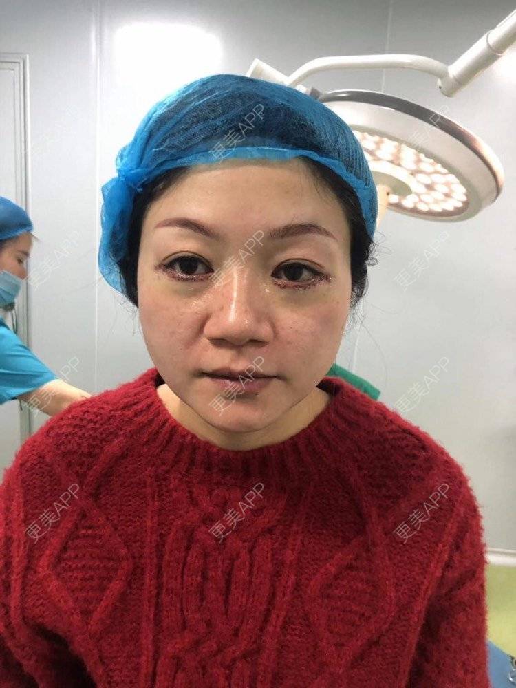 更美 - 更美用户x7RkAXFLs1的祛眼袋经验 | 内切去眼袋 | 祛眼袋 | 外切去眼袋 | 深圳