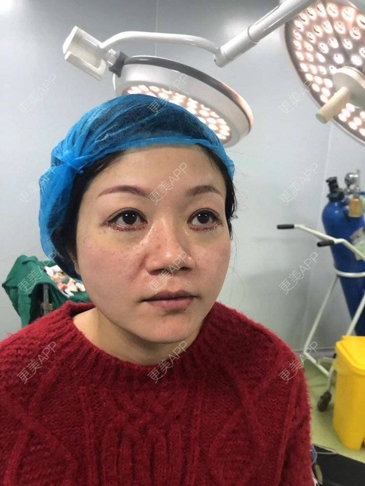 更美 - 更美用户x7RkAXFLs1的祛眼袋经验 | 内切去眼袋 | 祛眼袋 | 外切去眼袋 | 深圳