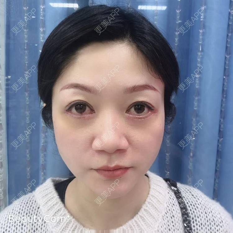 更美 - 更美用户x7RkAXFLs1的祛眼袋经验 | 祛眼袋 | 外切去眼袋 | 深圳 | 内切去眼袋