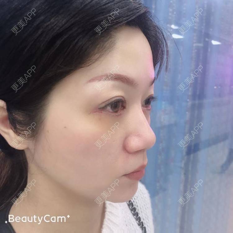 更美 - 更美用户x7RkAXFLs1的祛眼袋经验 | 祛眼袋 | 外切去眼袋 | 深圳 | 内切去眼袋