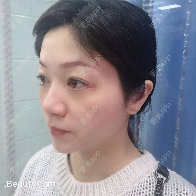更美 - 更美用户x7RkAXFLs1的祛眼袋经验 | 祛眼袋 | 外切去眼袋 | 深圳 | 内切去眼袋