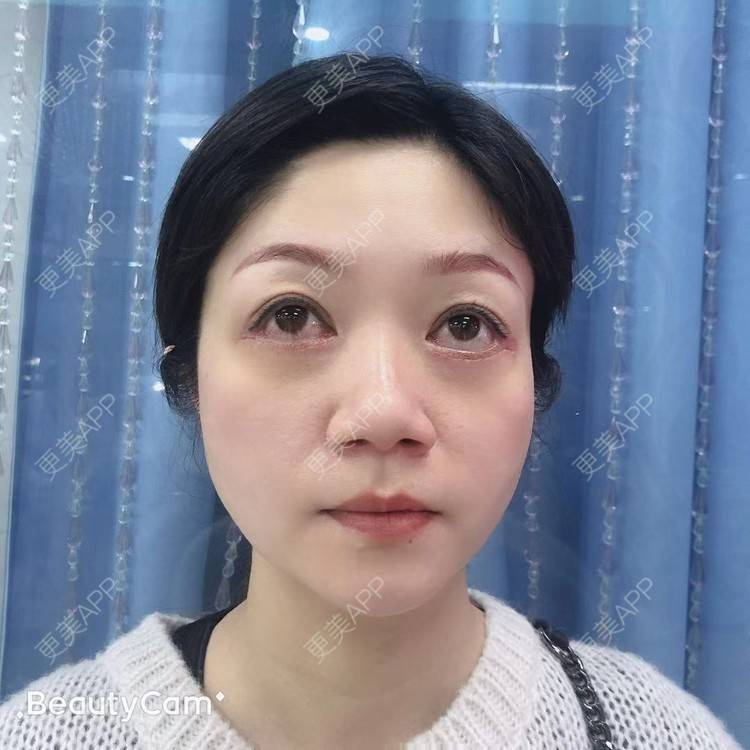 更美 - 更美用户x7RkAXFLs1的祛眼袋经验 | 祛眼袋 | 外切去眼袋 | 深圳 | 内切去眼袋