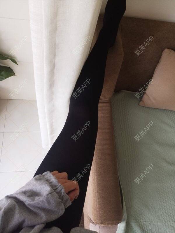 更美 - 请叫我小花的吸脂瘦大腿经验 | 吸脂瘦大腿 | 北京