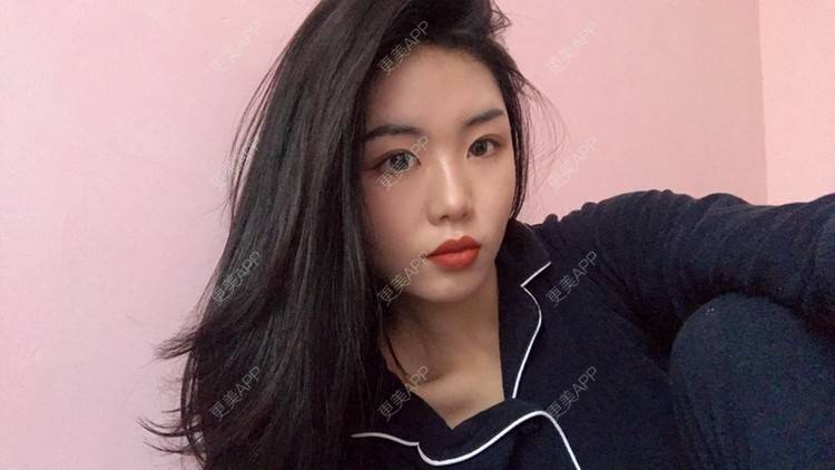 更美 - 天使般美丽的颧骨颧弓经验 | 颧骨内推 | 颧骨颧弓 | 武汉 | 面部不对称矫正 | 颧弓降低