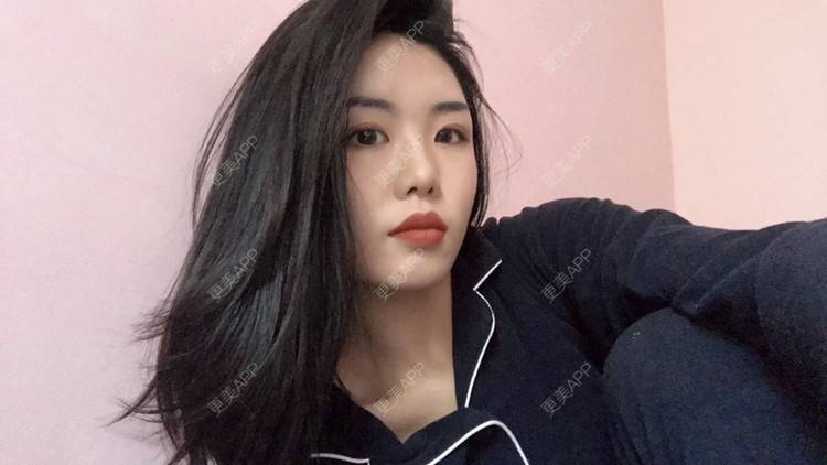 更美 - 天使般美丽的颧骨颧弓经验 | 颧骨内推 | 颧骨颧弓 | 武汉 | 面部不对称矫正 | 颧弓降低