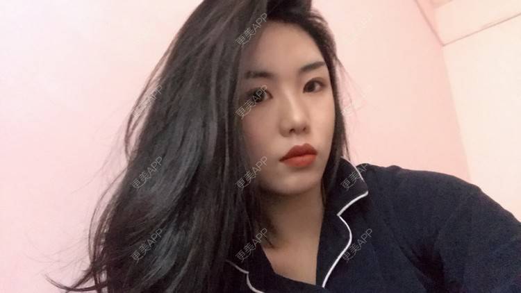 更美 - 天使般美丽的颧骨颧弓经验 | 颧骨内推 | 颧骨颧弓 | 武汉 | 面部不对称矫正 | 颧弓降低