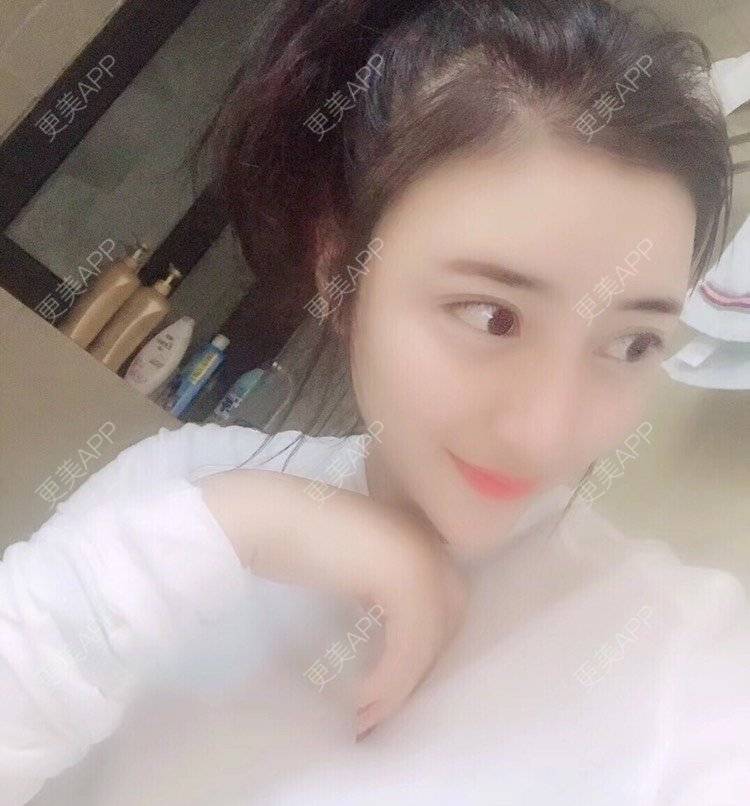 更美 - 好好心情的自体脂肪丰苹果肌经验 | 自体脂肪丰苹果肌 | 自体脂肪垫下巴 | 自体脂肪丰太阳穴 | 自体脂肪丰额头 | 杭州 | 自体脂肪全面部填充