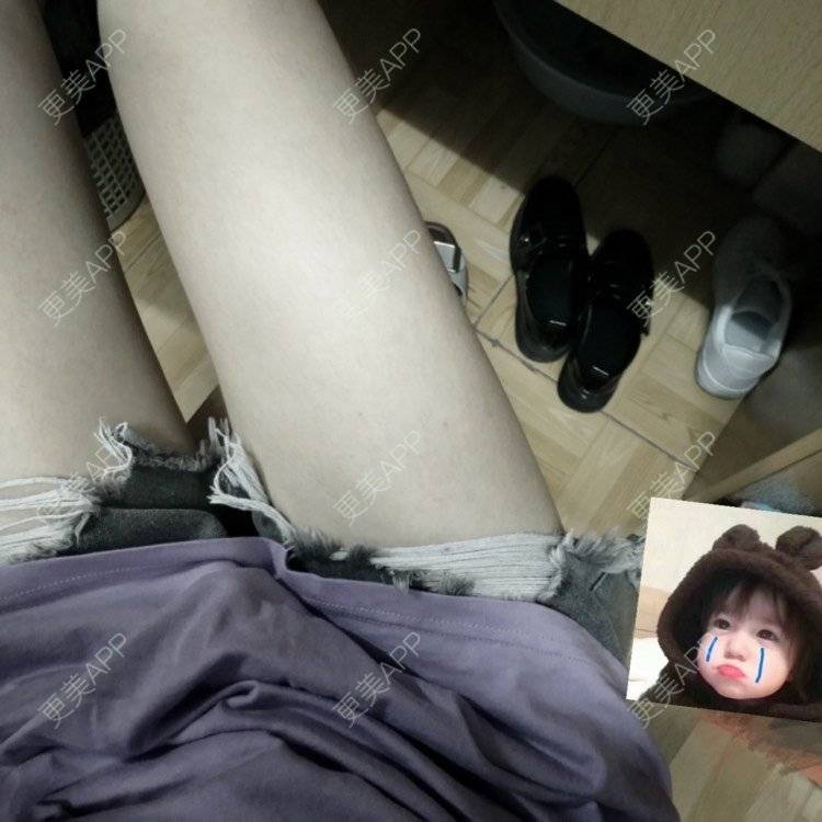 更美 - 好好心情的腰腹吸脂经验 | 腰腹吸脂 | 背部吸脂 | 吸脂瘦大腿 | 手臂吸脂 | 杭州