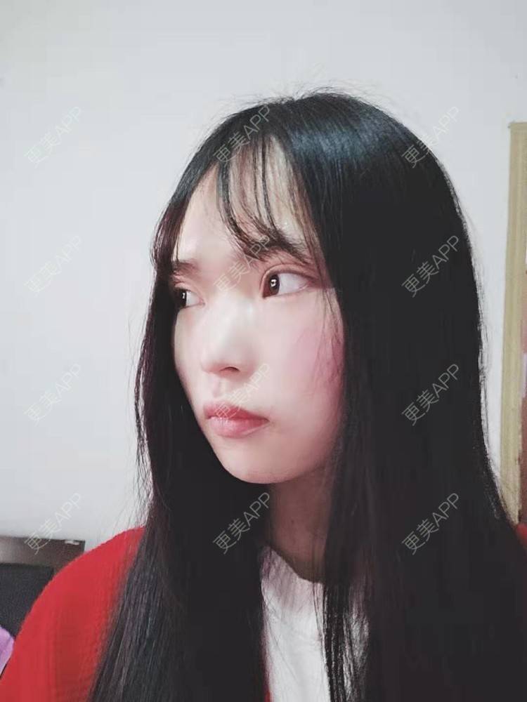 更美 - 刘晋军 医生的全切双眼皮经验 | 眼部多项 | 全切双眼皮 | 南京 | 双眼皮