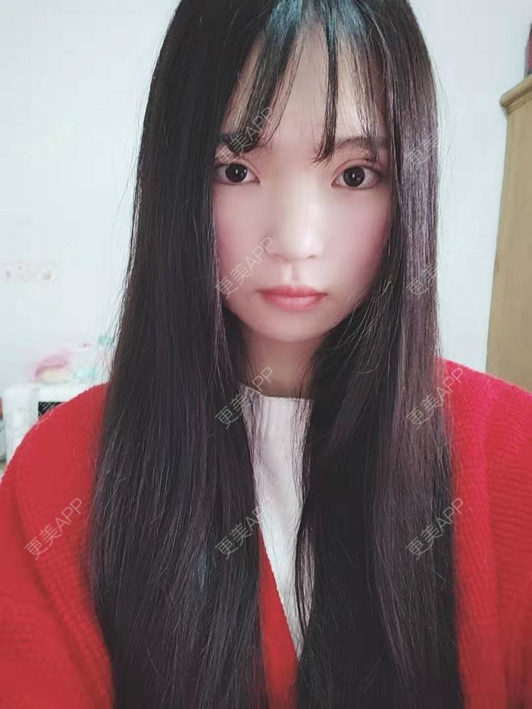 更美 - 刘晋军 医生的全切双眼皮经验 | 眼部多项 | 全切双眼皮 | 南京 | 双眼皮