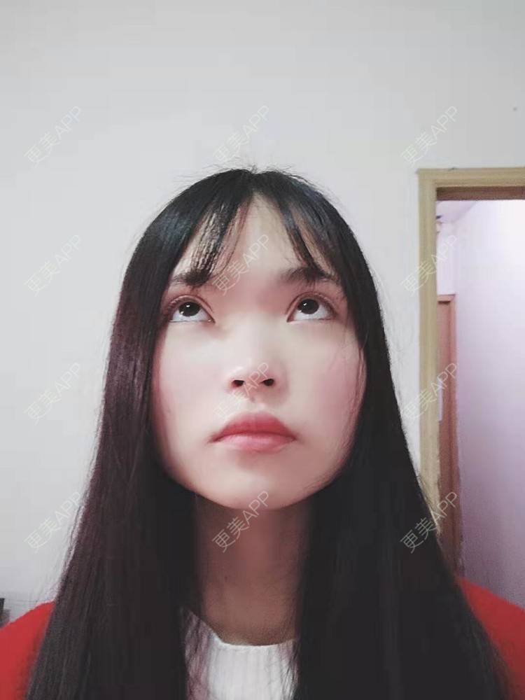 更美 - 刘晋军 医生的全切双眼皮经验 | 眼部多项 | 全切双眼皮 | 南京 | 双眼皮