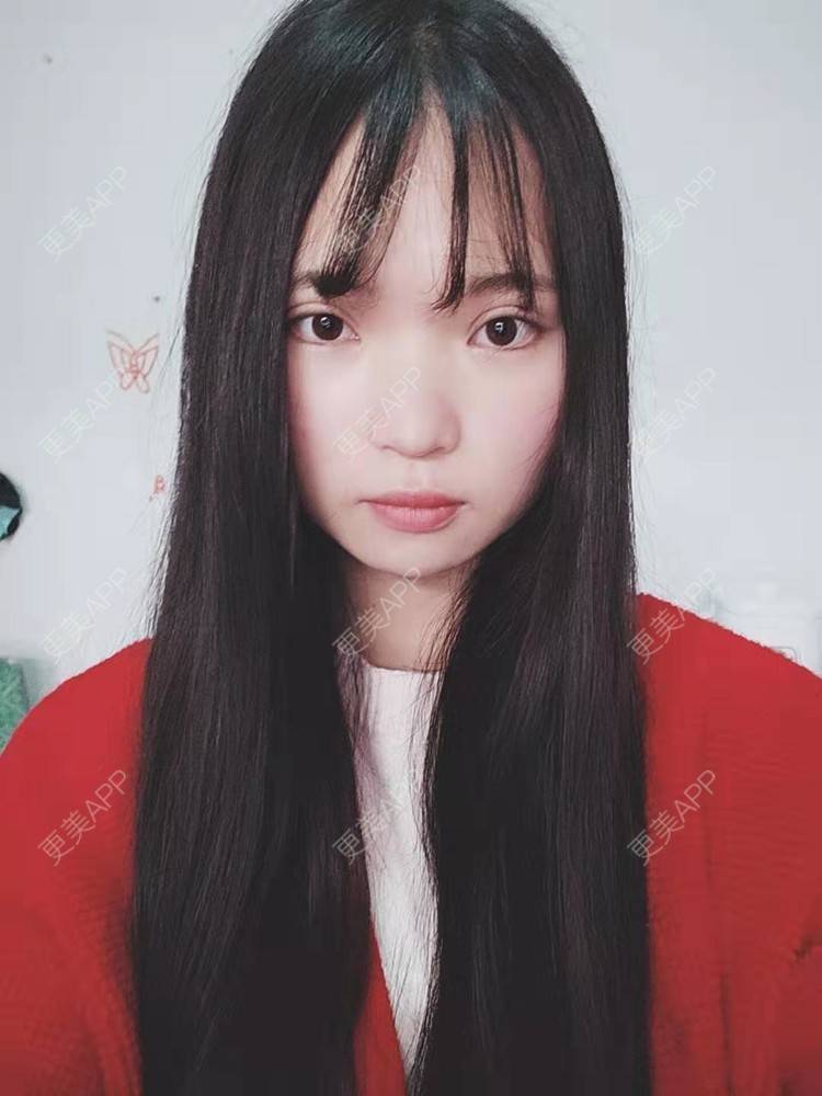 更美 - 刘晋军 医生的鼻部硅胶假体取出经验 | 鼻部修复 | 南京 | 鼻形态修复 | 鼻部硅胶假体取出