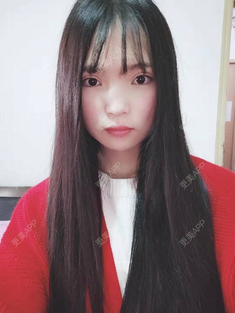 更美 - 刘晋军 医生的鼻部硅胶假体取出经验 | 鼻部修复 | 南京 | 鼻形态修复 | 鼻部硅胶假体取出