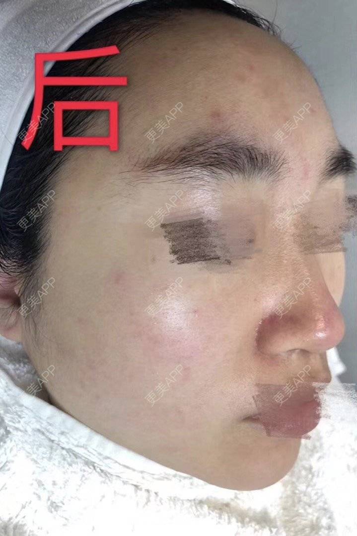 更美 - 悦怡姐姐的水氧活肤经验 | 水氧活肤 | 皮肤综合管理套餐 | 上海