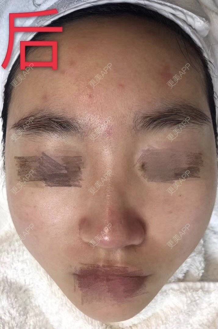 更美 - 悦怡姐姐的水氧活肤经验 | 水氧活肤 | 皮肤综合管理套餐 | 上海