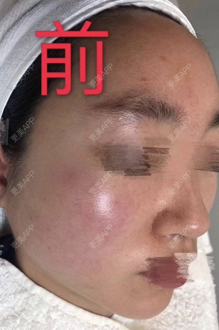 更美 - 悦怡姐姐的水氧活肤经验 | 水氧活肤 | 皮肤综合管理套餐