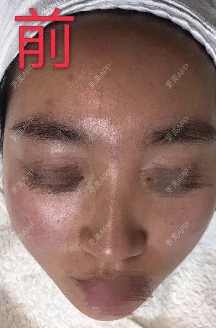 更美 - 悦怡姐姐的水氧活肤经验 | 水氧活肤 | 皮肤综合管理套餐