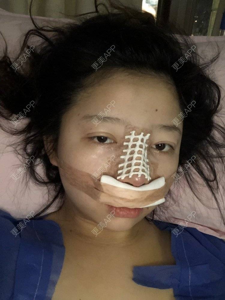 更美 - 更美用户JMQLbybsLF的膨体隆鼻经验 | 膨体隆鼻 | 肋软骨隆鼻 | 鼻小柱延长 | 成都