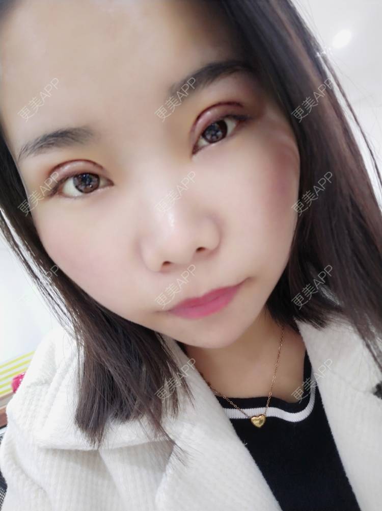 全切双眼皮效果图_更美用户xqkqu69meo全切双眼皮效果图_术后34天__更