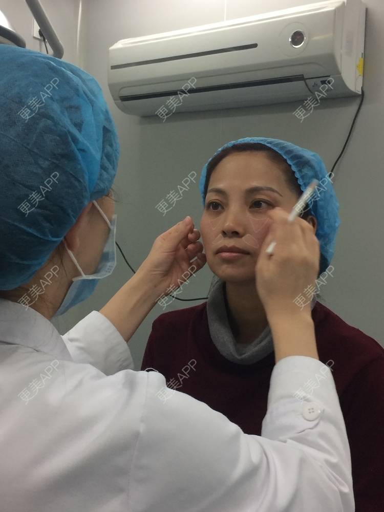 更美 - 更美用户EWi3oovLr0的射频提升经验 | 武汉 | 射频提升