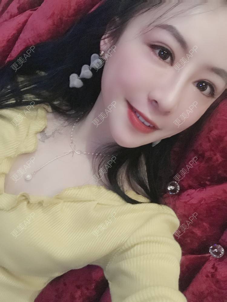 更美 - 卡门小妖精，的玻尿酸卧蚕经验 | 玻尿酸卧蚕 | 重庆 | 自体脂肪丰卧蚕 | 真皮丰卧蚕 | 双眼皮修复 | 眼部多项