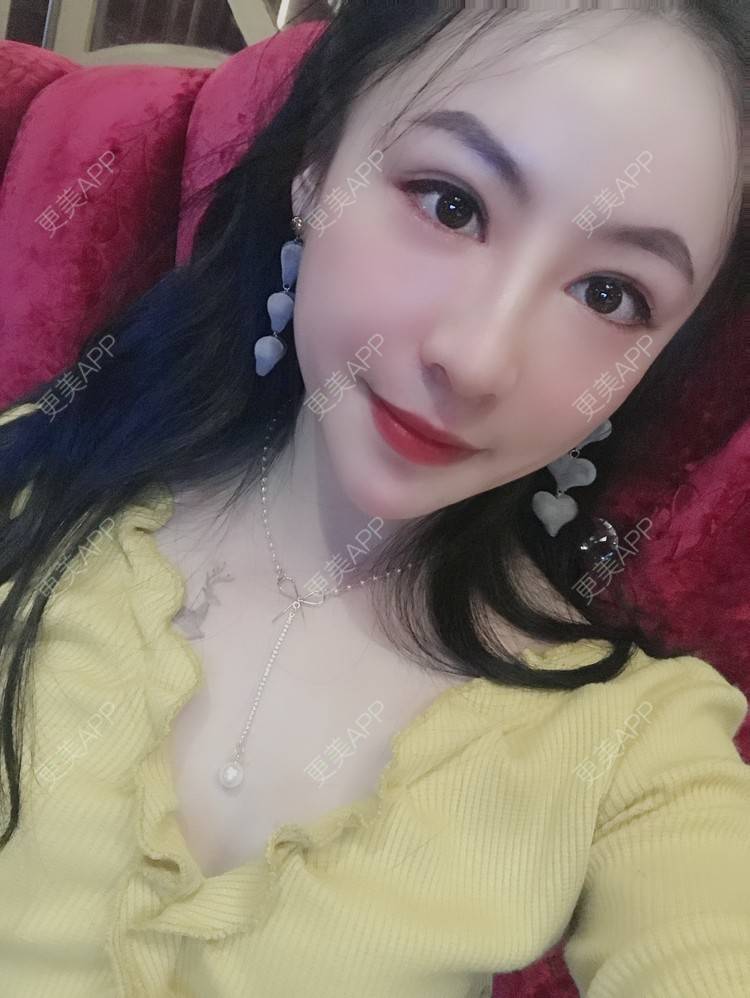 更美 - 卡门小妖精，的玻尿酸卧蚕经验 | 玻尿酸卧蚕 | 重庆 | 自体脂肪丰卧蚕 | 真皮丰卧蚕 | 双眼皮修复 | 眼部多项