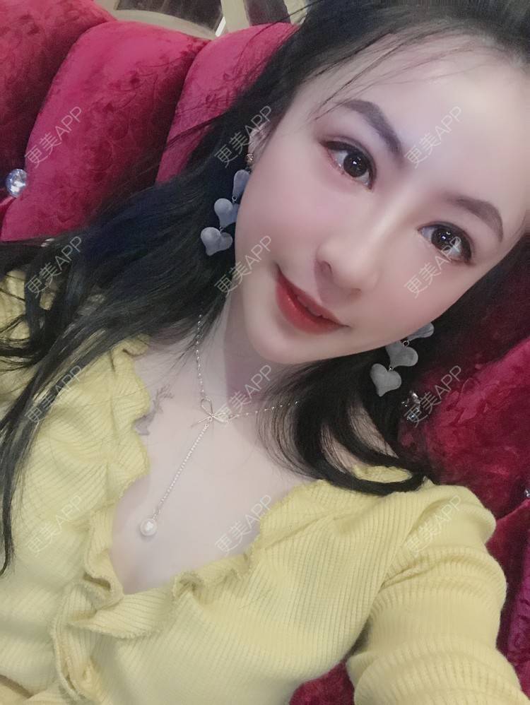 更美 - 卡门小妖精，的玻尿酸卧蚕经验 | 玻尿酸卧蚕 | 重庆 | 自体脂肪丰卧蚕 | 真皮丰卧蚕 | 双眼皮修复 | 眼部多项