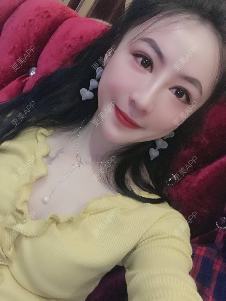 更美 - 卡门小妖精，的玻尿酸卧蚕经验 | 玻尿酸卧蚕 | 重庆 | 自体脂肪丰卧蚕 | 真皮丰卧蚕 | 双眼皮修复 | 眼部多项