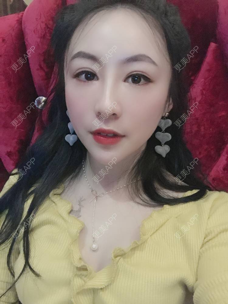 更美 - 卡门小妖精，的玻尿酸卧蚕经验 | 玻尿酸卧蚕 | 重庆 | 自体脂肪丰卧蚕 | 真皮丰卧蚕 | 双眼皮修复 | 眼部多项