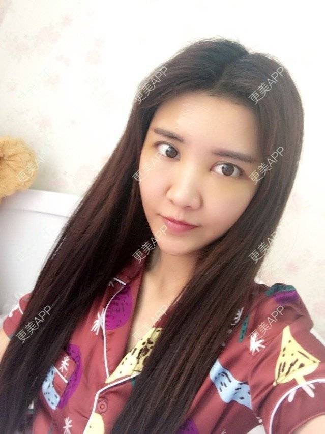 更美 - 菲菲菲姐的自体脂肪面部填充日记 | 自体脂肪面部填充 | 重庆