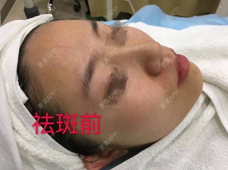 更美 - 悦怡姐姐的激光淡斑经验 | 激光淡斑 | 淡斑套餐 | 上海
