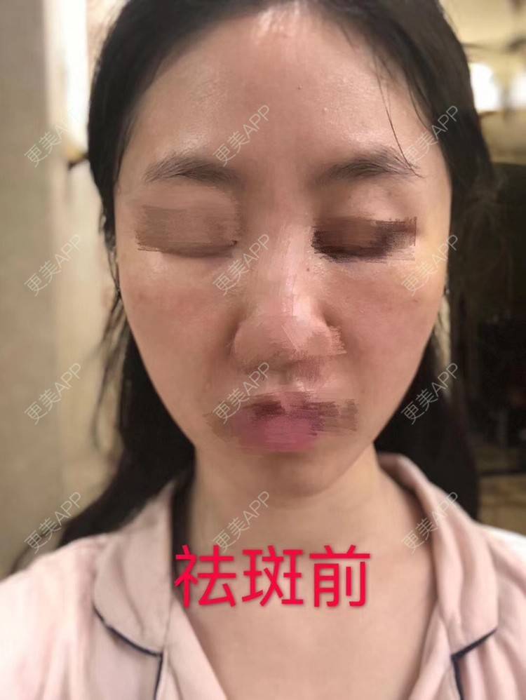 更美 - 悦怡姐姐的激光淡斑经验 | 激光淡斑 | 淡斑套餐 | 上海