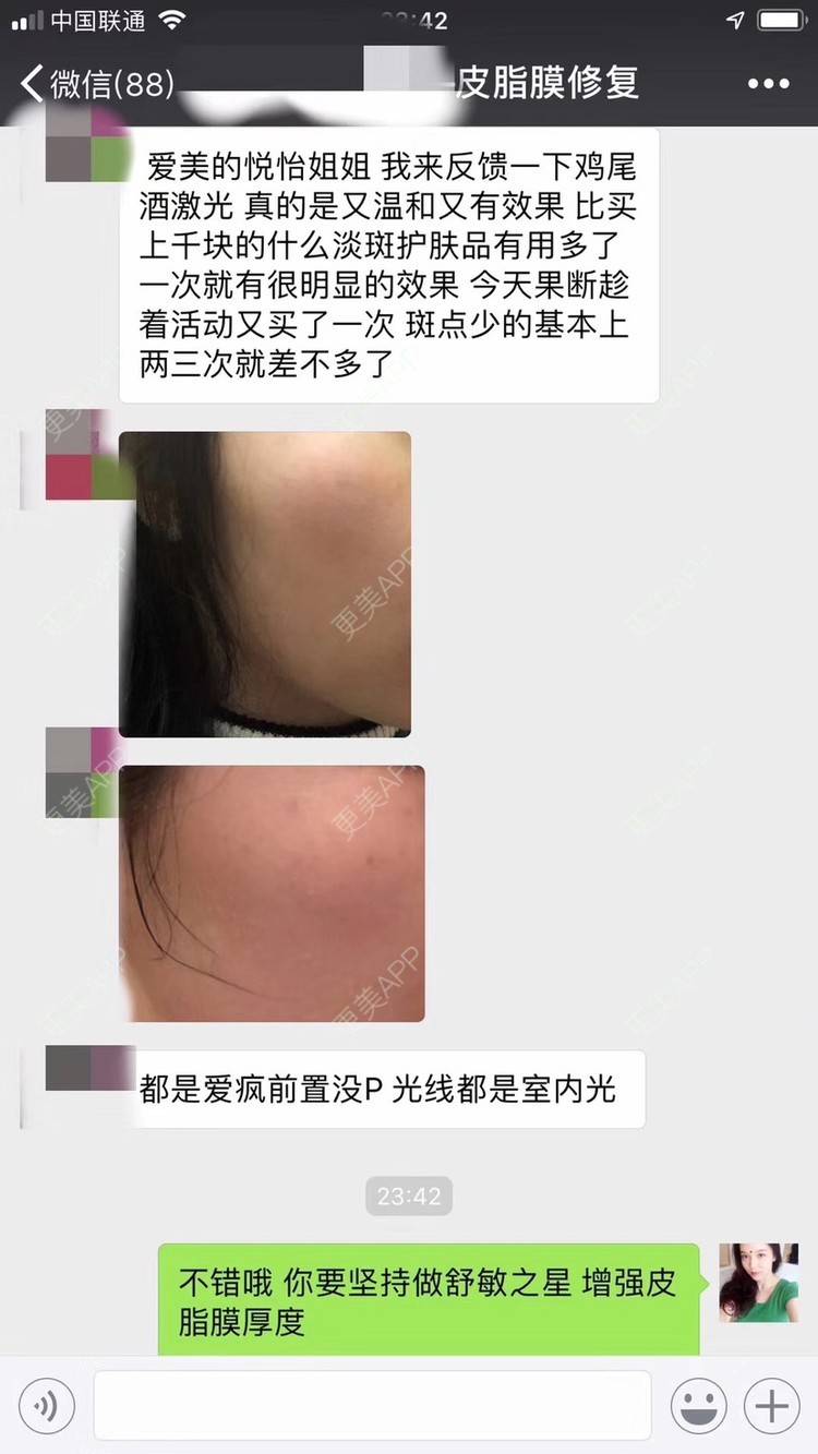 更美 - 悦怡姐姐的激光淡斑经验 | 激光淡斑 | 淡斑套餐 | 上海