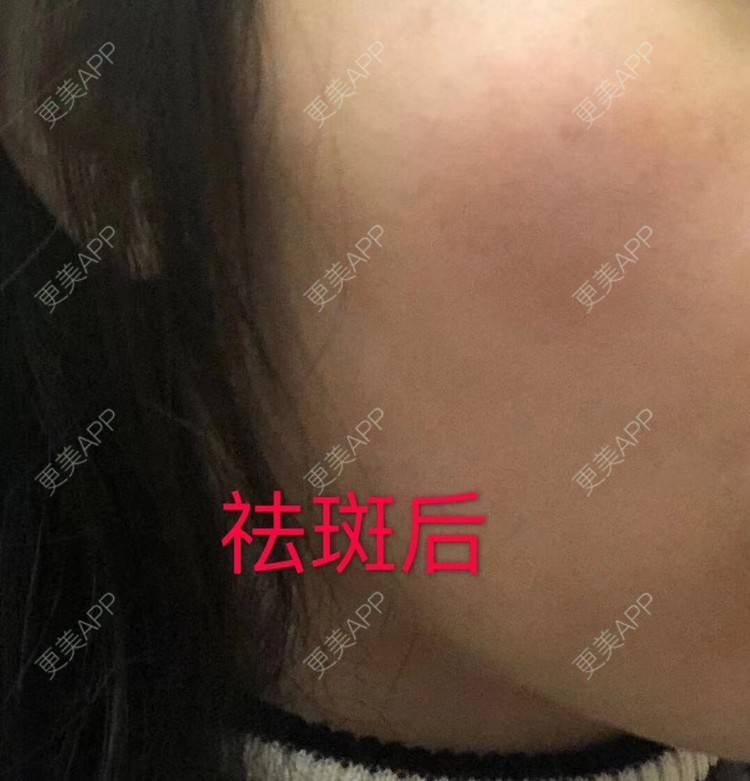 更美 - 悦怡姐姐的激光淡斑经验 | 激光淡斑 | 淡斑套餐 | 上海