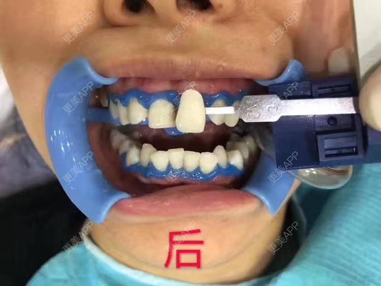 更美 - 悦怡姐姐的冷光美白经验 | 冷光美白 | 上海