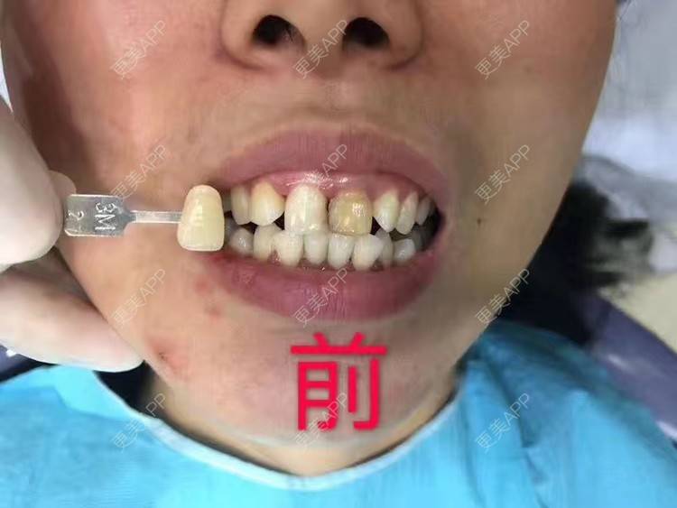 更美 - 悦怡姐姐的冷光美白经验 | 冷光美白 | 上海