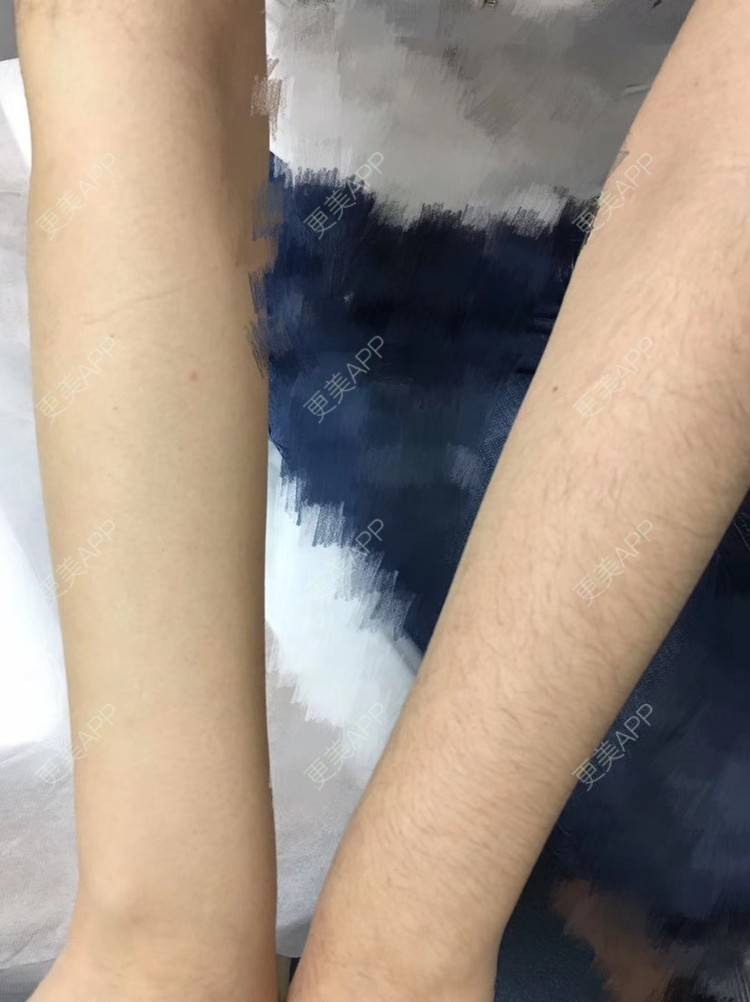 更美 - 悦怡姐姐的手臂脱毛经验 | 手臂脱毛 | 大腿脱毛 | 上海
