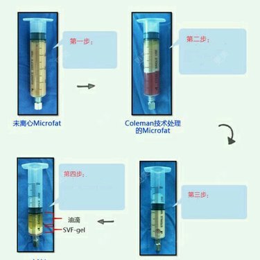 自体脂肪丰面颊