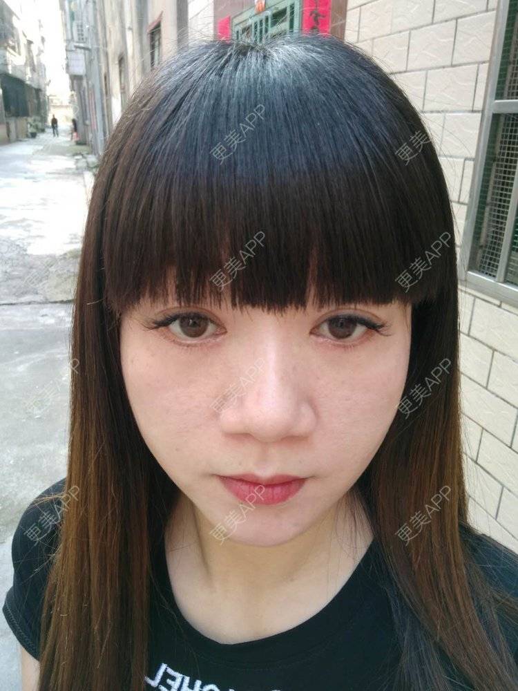更美 - 更美用户x7RkAXFLs1的祛眼袋经验 | 祛眼袋 | 外切去眼袋 | 深圳 | 内切去眼袋