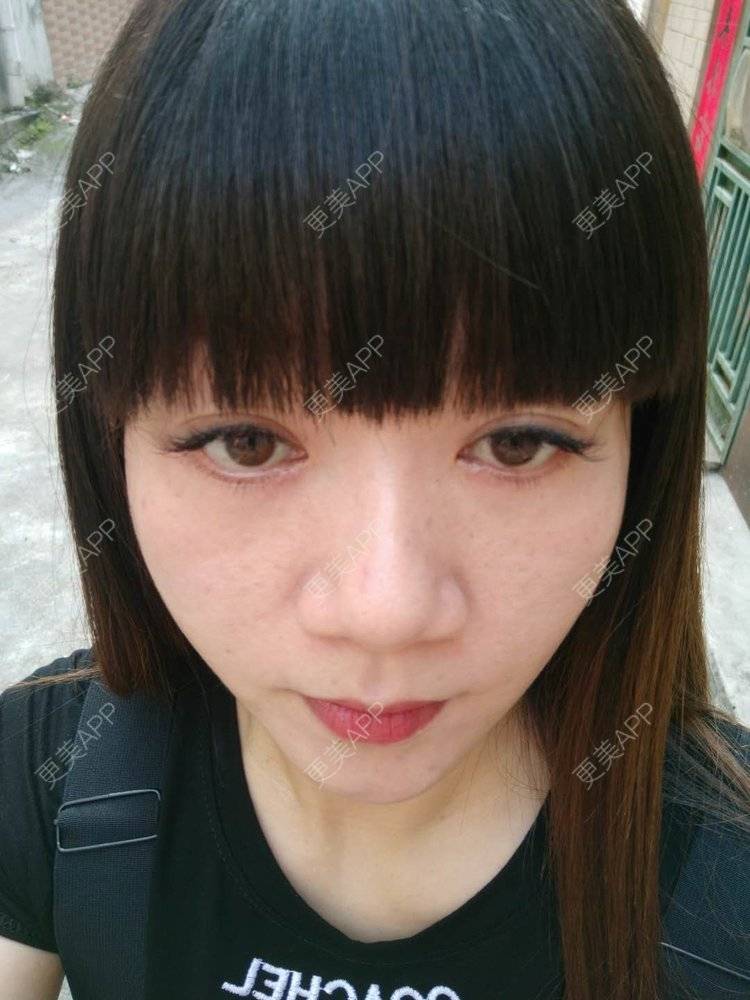 更美 - 更美用户x7RkAXFLs1的祛眼袋经验 | 祛眼袋 | 外切去眼袋 | 深圳 | 内切去眼袋