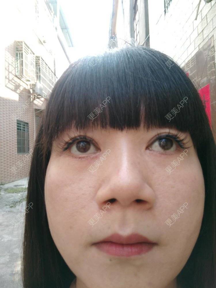 更美 - 更美用户x7RkAXFLs1的祛眼袋经验 | 祛眼袋 | 外切去眼袋 | 深圳 | 内切去眼袋