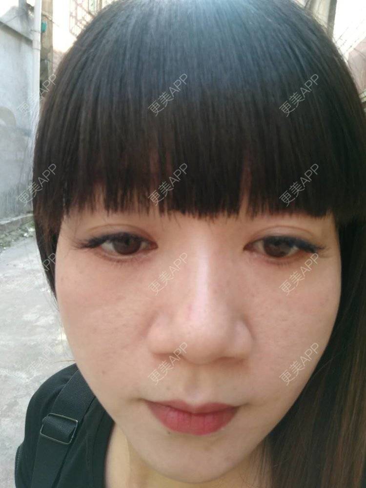 更美 - 更美用户x7RkAXFLs1的祛眼袋经验 | 祛眼袋 | 外切去眼袋 | 深圳 | 内切去眼袋